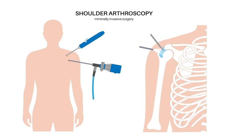 cirugía artroscopia hombro